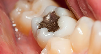 dental-fillings-toronto