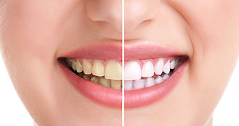 teeth-whitening