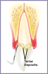 Mild Periodontis